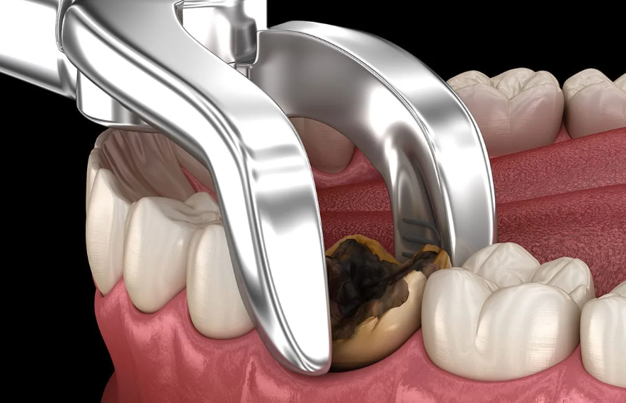 الخلع الجراحي للأسنان (Surgical Tooth Extraction)